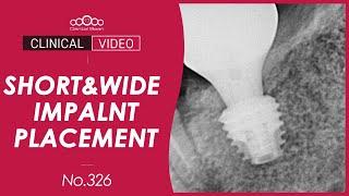 Short Implant Placement for Short Space with IAN [Dr. Kim Jaeyoon]