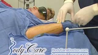 ft. lauderdale cosmetic surgery - liposculpture of the arms - smartlipo arms