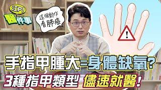 指甲能看出癌症訊息？ 指甲腫大 是 身體缺氧 ？這3種指甲恐罹癌 請盡速就醫！【 江P醫件事 136】 江坤俊醫師