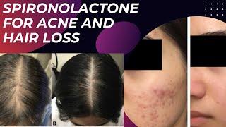 Spironolactone for acne and hair loss - dermatologist explains