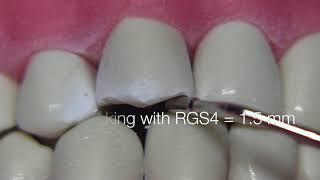 Porcelain Fused to Metal Crown Preparation - PFM Canine