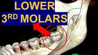 Secrets of Impacted Lower Third Molars: CBCT Surgical extraction of wisdom teeth removal surgery