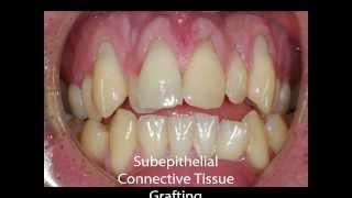 Mucogingival Procedures: Root Coverage of Gingival (Gum) Recessions