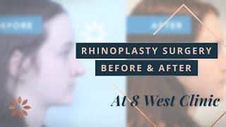 Rhinoplasty Transformations - Before & After Pictures | Dr. Buonassisi, 8 West Clinic in Vancouver