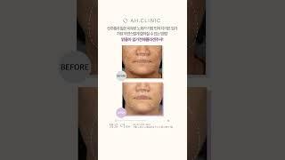선주름과 얇은 피부로 노화가 가장 먼저 다가온 입가 가장 자연스럽게 젊어질 수 있는 방법! 맑을아 입가전체 콜라겐 주사!  #팔자주름 #입가주름 #팔자선주름 #자가진피재생술