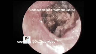 Relax Every Day With Dr Zhao Video ear spa satisfying #0123