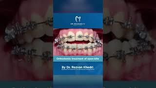 Orthodontic correction of open bite and cross bite by our Orthodontist Dr Rezvan