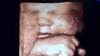 Baby Isla - 36Wks - 4D Ultrasound