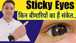 Sticky Eyes ( आँख से कीचड़ आना ) कारण और उपचार || How to treat sticky eyes.