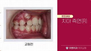 송곳니가 앞니와 작은 어금니 사이에 끼어있는 덧니 11세 어린이 치료