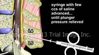 Epidural Spinal Anesthesia - Animation by Dr. Cal Shipley, M.D.