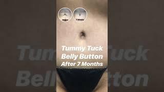 Belly Button | Tummy Tuck | Results | Beverly Hills | Los Angeles | Plastic Surgery