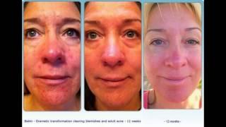 Jeunesse LUMINESCE™Cellular Rejuvenation Serum Before & After