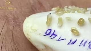 Loan Nguyen Acne Treatment 0003