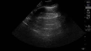 Sliding pleural lineas A nº3