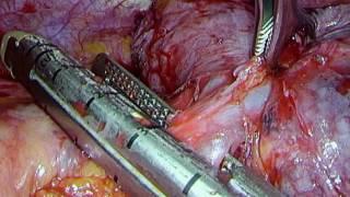 Thoracic Surgery: VATS Left Pneumonectomy