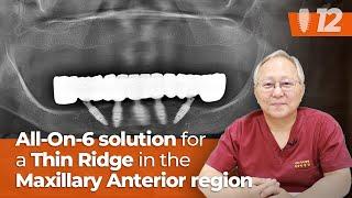 All-On-6 solution for a Thin Ridge in the Maxillary Anterior region