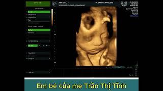 EM BÉ CỦA MẸ TRẦN THỊ TĨNH - VIỆT XUÂN VĨNH TƯỜNG VĨNH PHÚC - THAI 28 TUẦN 1 NGÀY