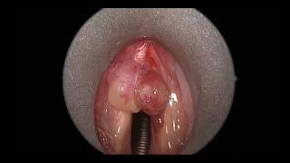 Large Vocal Cord Polyp Causing Hoarse Voice