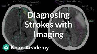 Diagnosing strokes with imaging CT, MRI, and Angiography | NCLEX-RN | Khan Academy