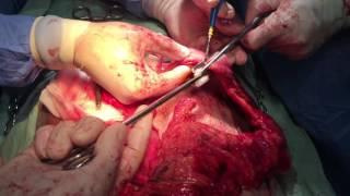 Megacolon, Total abdominal colectomy - performed by Sahib Huseynov M.D (Doctor of Medicine)