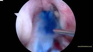Arthroscopic "Stem Cell" ACL Injection with blue dye (#2)
