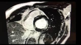Late Gadolinium Enhancement CMRI showing Scar post Myocardial Infarction