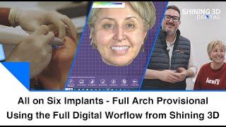 All On Six Implants I Temporary Full Arch Rehabilitation I Shining 3D Full Digital Workflow