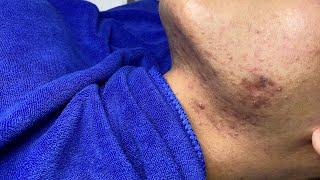 Acne Treatment For "Hung" (P18) | Điều Trị Mụn Cho Hùng (P18) - SacDepSpa#224