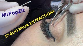 Eyelid MILIA removal. Soft touch required. Patient so happy, it was there a long time!