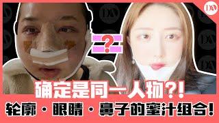 [韩国DA整形] DA前台小姐姐整容vlog-术后一周！