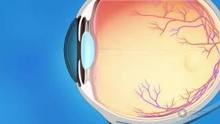 What is glaucoma?