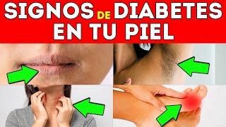 10 SEÑALES ALARMANTES de DIABETES en la PIEL