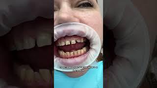 Зубы после обточки . Подготовка к установке виниров #виниры #стоматолог #smile