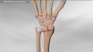 Distal Radius Fracture Repair (dorsal plating)