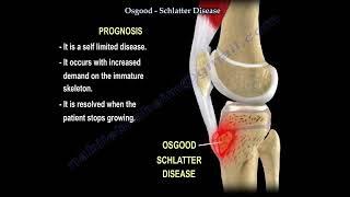 Osgood-Schlatter Disease