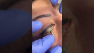 Could you handle this eyeliner tattoo removal? #shorts #dermatologist