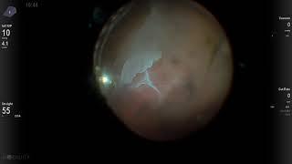 Recurrent RD with Sub Retinal PVR