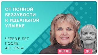 Как подготовиться к операции по установке имплантов? Рассказываю про свой опыт