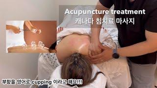 90% 가 모르시는 Acupunture 캐나다 중의학 침 치료 부항 효과에 대해서 / Acupuncture 마사지 / 침치료 마사지 목 어깨 뻐근 근육통 완화