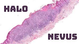 Halo nevus (nevus with brisk inflammation -brown skin spot with white pale halo around it) pathology