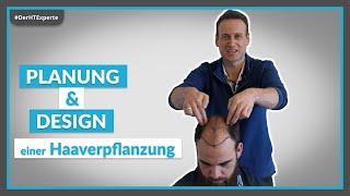 Die RICHTIGE Planung einer Haartransplantation [Neue Haarlinie]