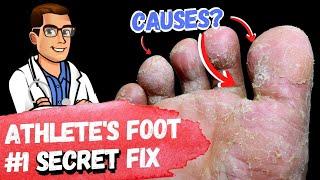 BEST 9 Athlete's Foot Fungus Remedies [& the #1 Big Mistake]