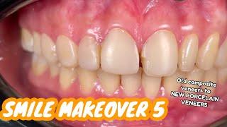 SMILE MAKEOVER 5 | Old composite veneers to a new PORCELAIN VENEERS | Dr. Bianca Beley