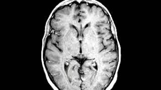 Metastatic Carcinoma of the colon Spatial