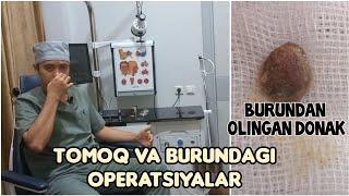 Tomoqdagi operatsiyadan keyin baribir tomoq og'rishi mumkin