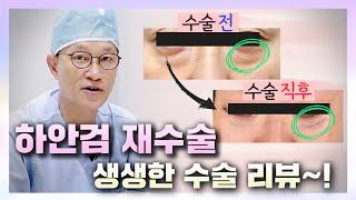 하안검성형 재수술 리뷰! 볼륨채우고 탄력채우고! [열린수신함 107편. 수술HAN썰]