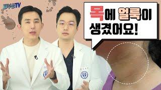 내 목이 얼룩덜룩 한 이유는 뭘까? - 색소침착? 어루러기? 흑피증? [피부과전문의 피부심]