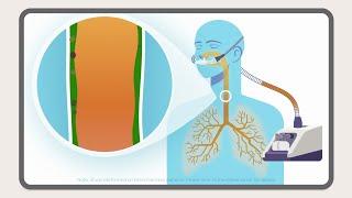 Der myAirvo™ 2: Ein System für die befeuchtete High-Flow-Therapie (German)