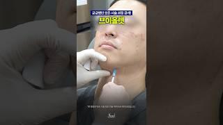 브이올렛 시술과정 대공개
